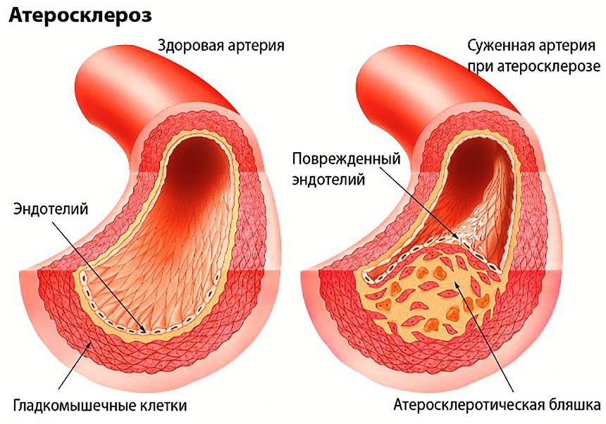 Ateroskleroz-po-Myasnikovu_2.jpg (86 KB)